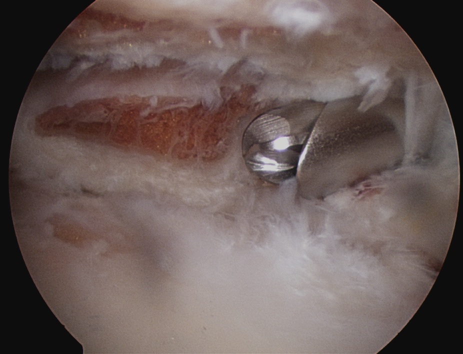 ACJ OA Debridement 1